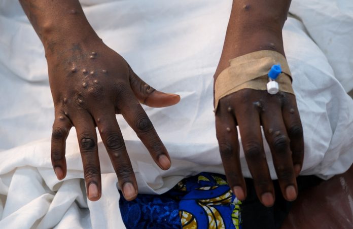 Mpox Cases in Uganda